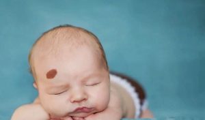 Vết bớt trên mặt có ý nghĩa gì? Giải mã từng vị trí theo nhân tướng học