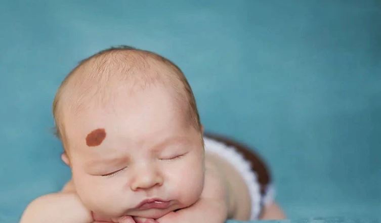 Vết bớt trên mặt có ý nghĩa gì? Giải mã từng vị trí theo nhân tướng học