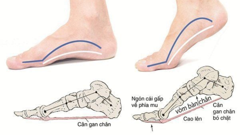 Vòm bàn chân cao thấp và vận mệnh: Góc nhìn từ nhân tướng học