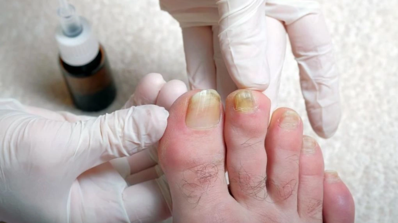 Nguyên nhân khiến móng chân đổi màu: Từ thói quen đến bệnh lý