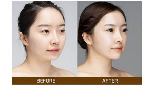 Tướng cằm và đường viền hàm